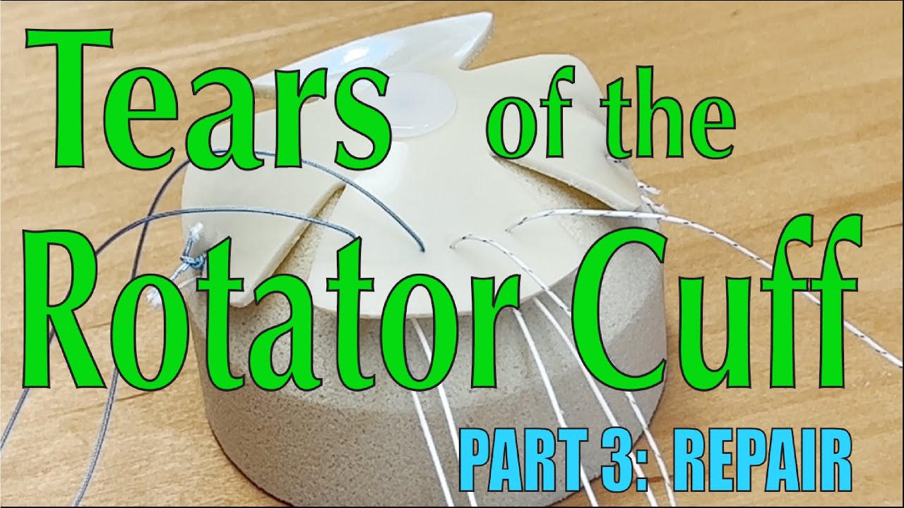 Tears of the Rotator Cuff Part 3: Suture Anchor Repair of the Rotator Cuff