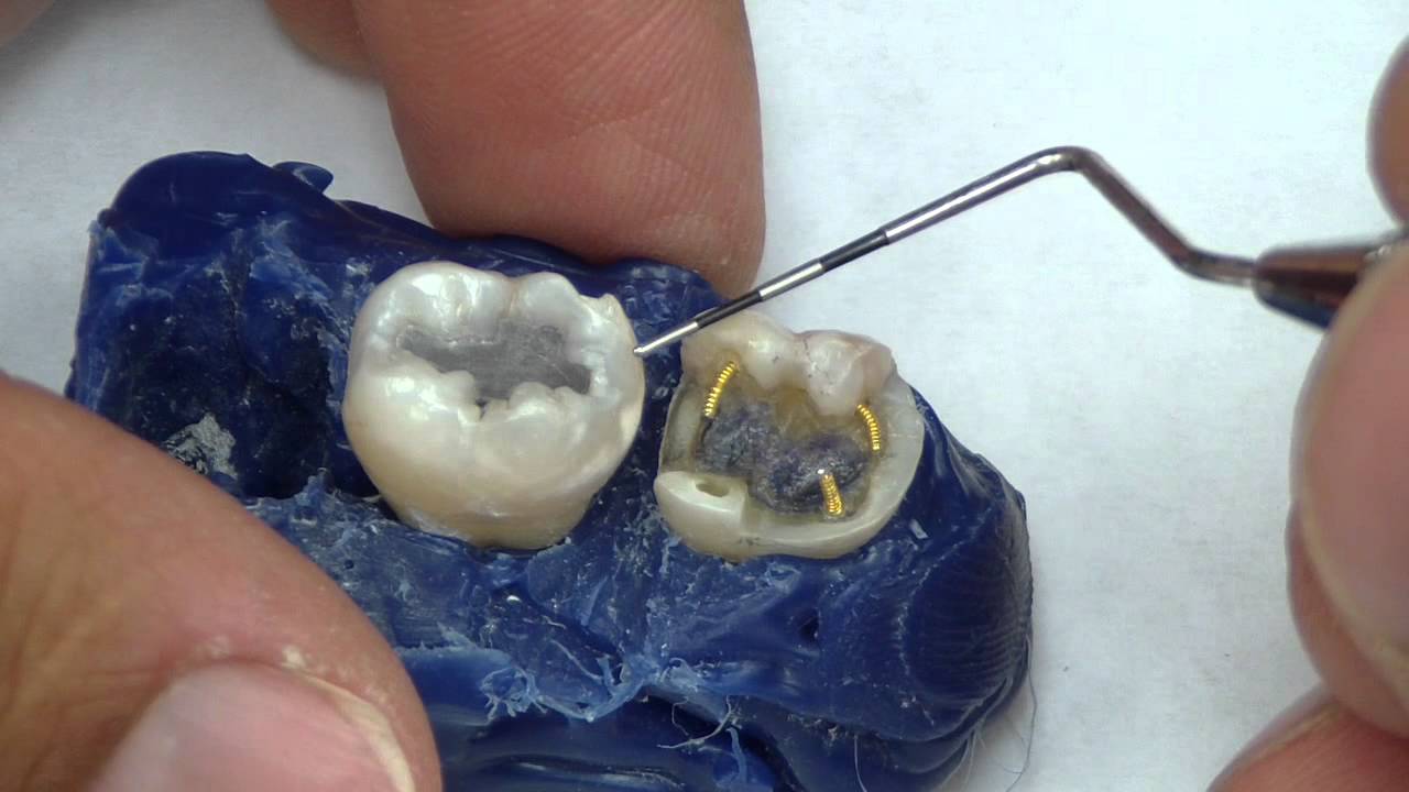 Complex Amalgam Retention
