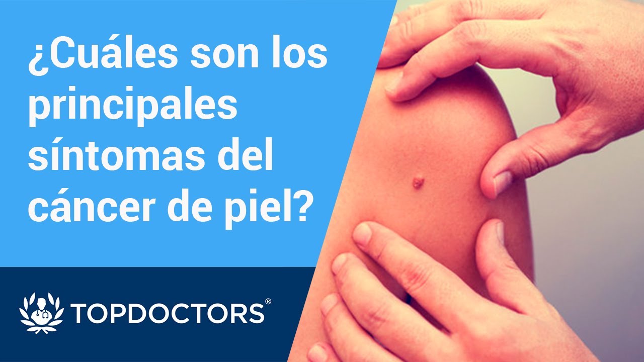 &iquest;Cu&aacute;les son los principales s&iacute;ntomas del c&aacute;ncer de piel? Dr. Fern&aacute;ndez Herrera (2/4)