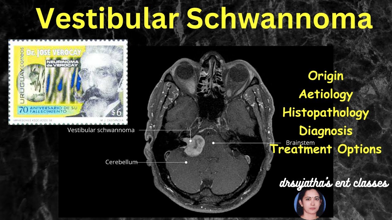 242.Vestibular Schwannoma   /  Acoustic neuroma  