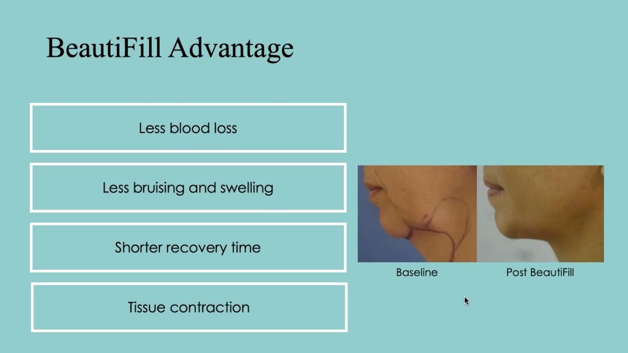 Guide To Integrating Autologous Fat Transfer To Your Practice