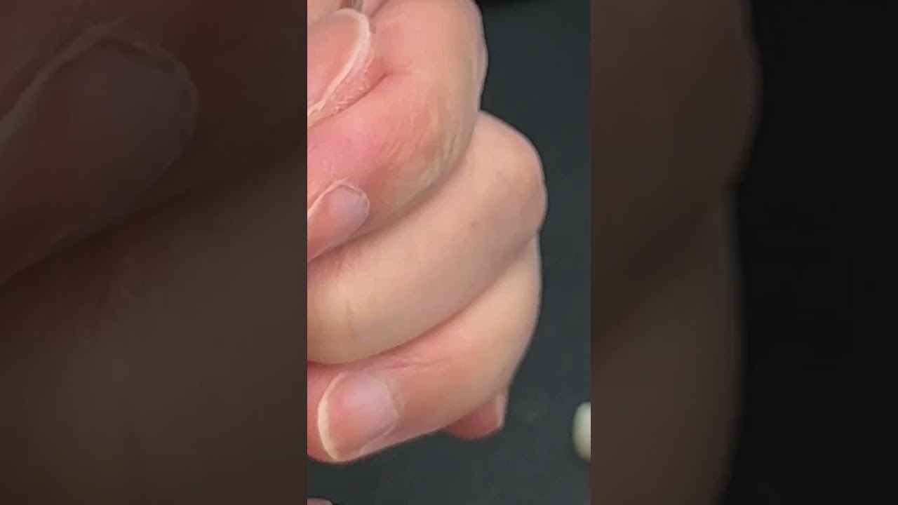 Building-Up a Luxurious Full Mouth Arch Implant
