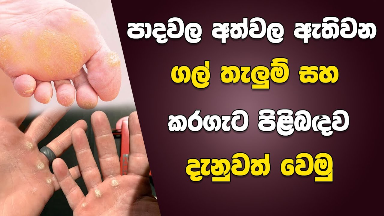 පාදවල අත්වල ඇතිවන ගල් තැලුම් සහ කරගැට පිළිබඳ ව දැනුවත් වෙමු | Corns and Calluses in&nbsp;Hands&nbsp;and&nbsp;Feet