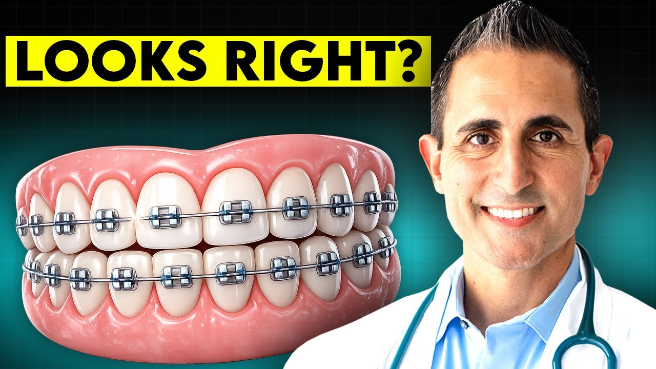 Why “Fast Braces” Often Don’t End How Patients Expect