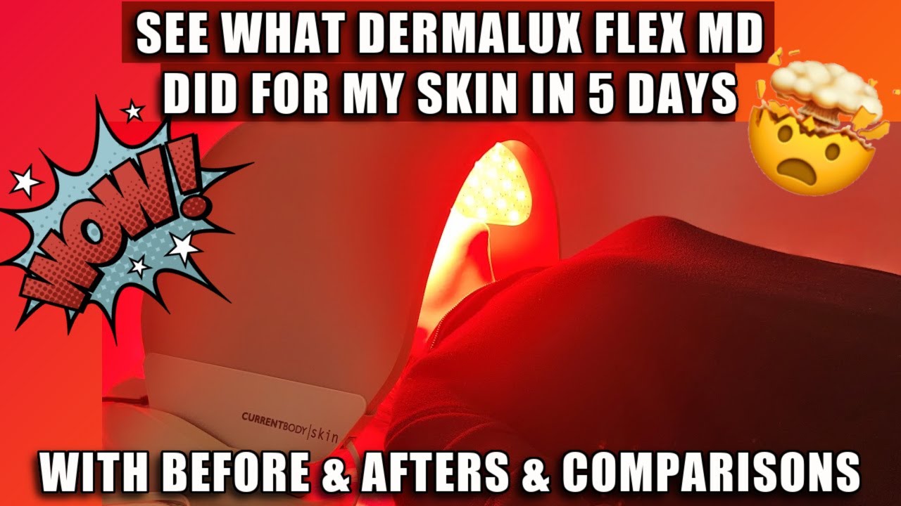 5 Days With the Most Expensive LED Panel on My Face - CURRENTBODY DERMALUX FLEX MD