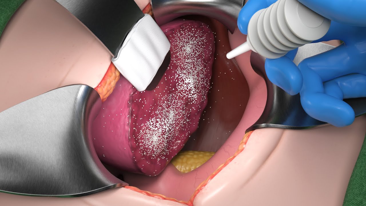 [메디컬 애니메이션] BleeFix : Absorbable Surgical Hemostat