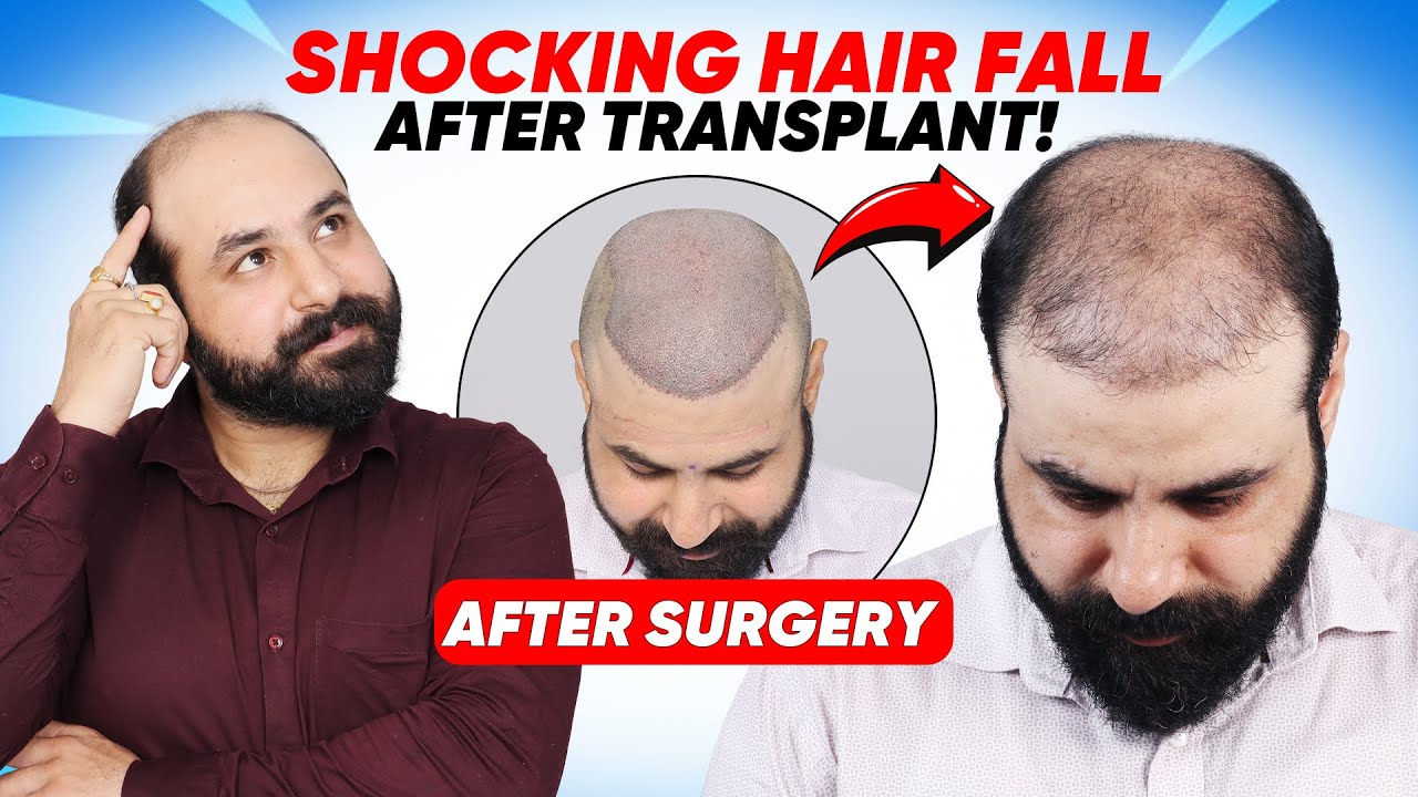 Hair Transplant in Delhi (HX-JKLG) | Best Results & Cost of Hair Transplant in Delhi