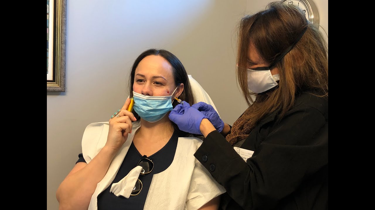Versa for Tear Trough Enhancement