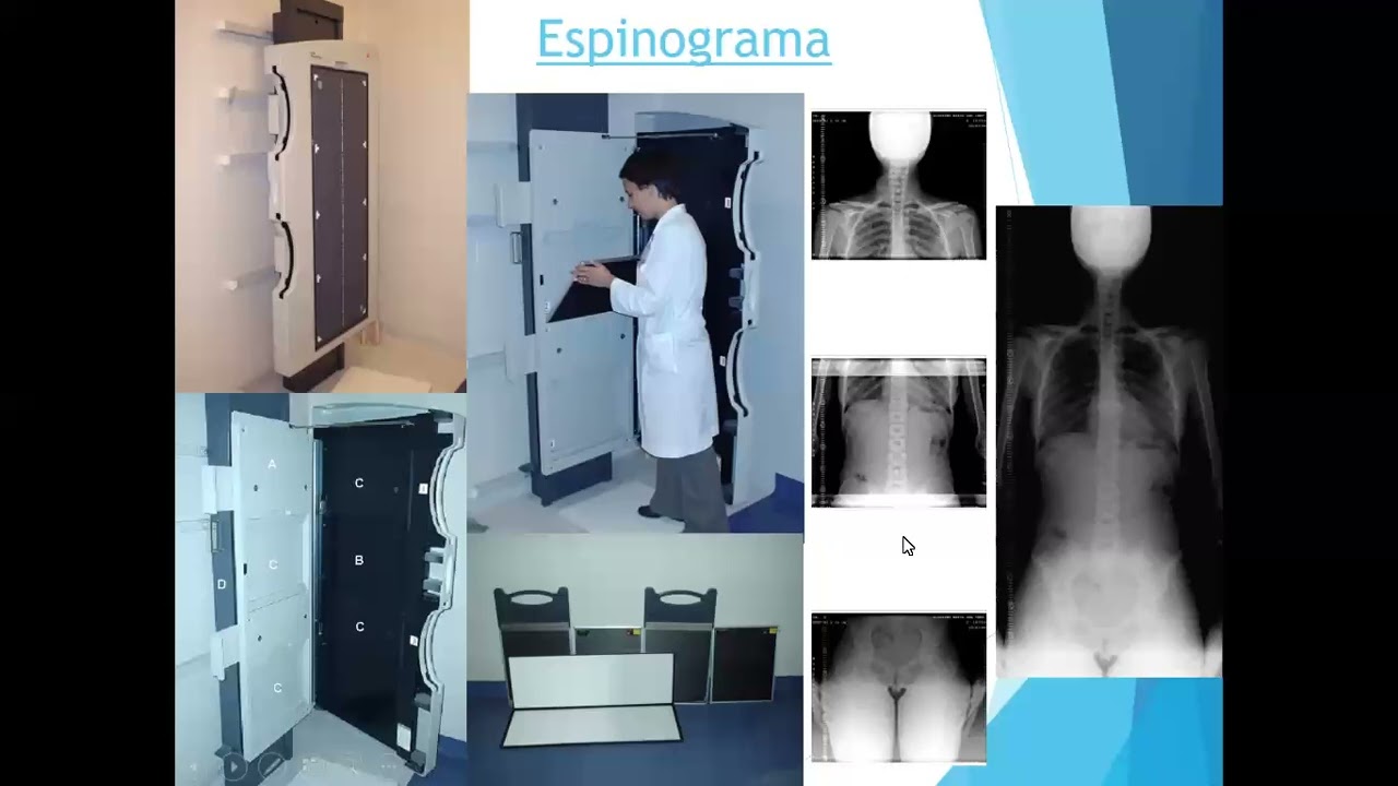 Escoliosis