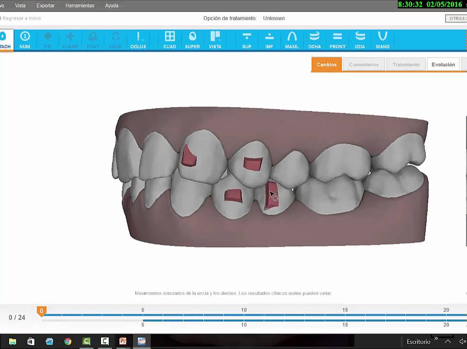 Invisalign Tips to solve a Deepbite and a Class II malocclusion