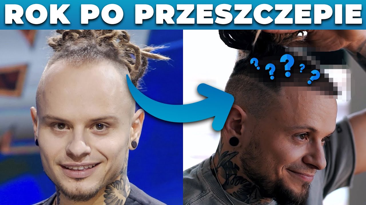 Mateusz z FitLovers Rok Po Przeszczepie Włosów w Turcji *Niesamowity Efekt Końcowy*