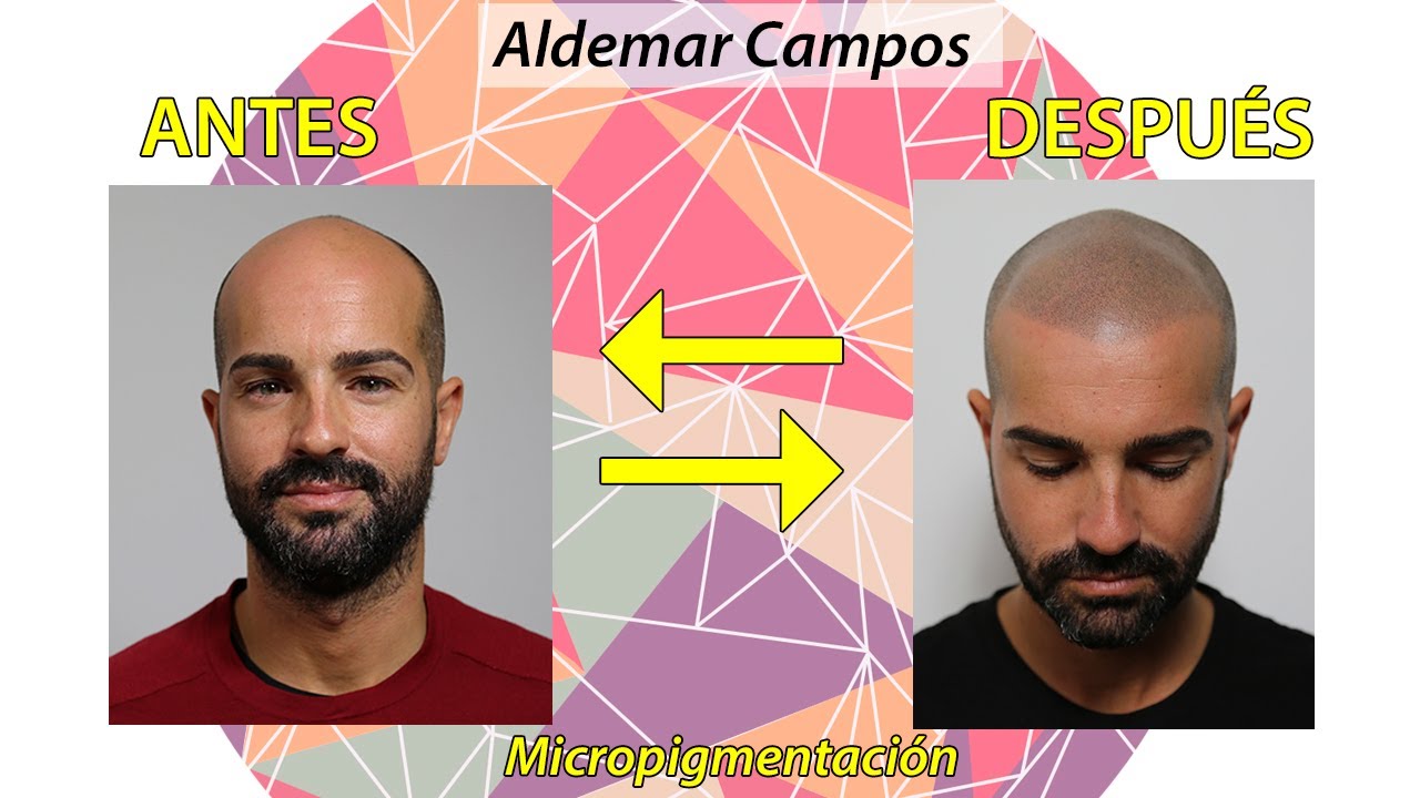 [ENGLISH SUB] Micropigmentación Capilar: Antes y después