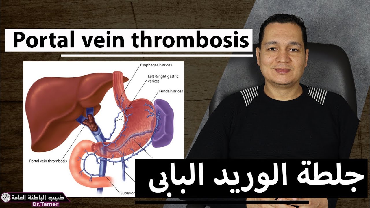 جلطة الوريد البابى / Portal vein thrombosis