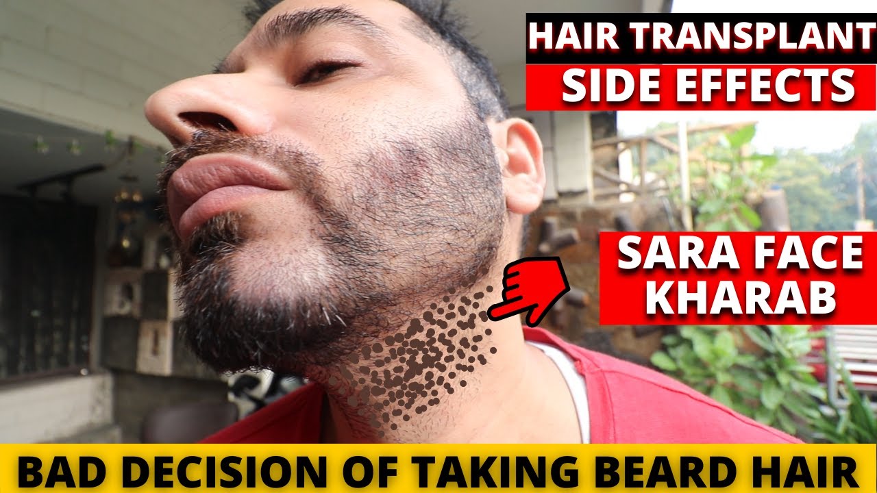 Did hair transplant Destroyed my face | Beard hair for transplant | Born creator