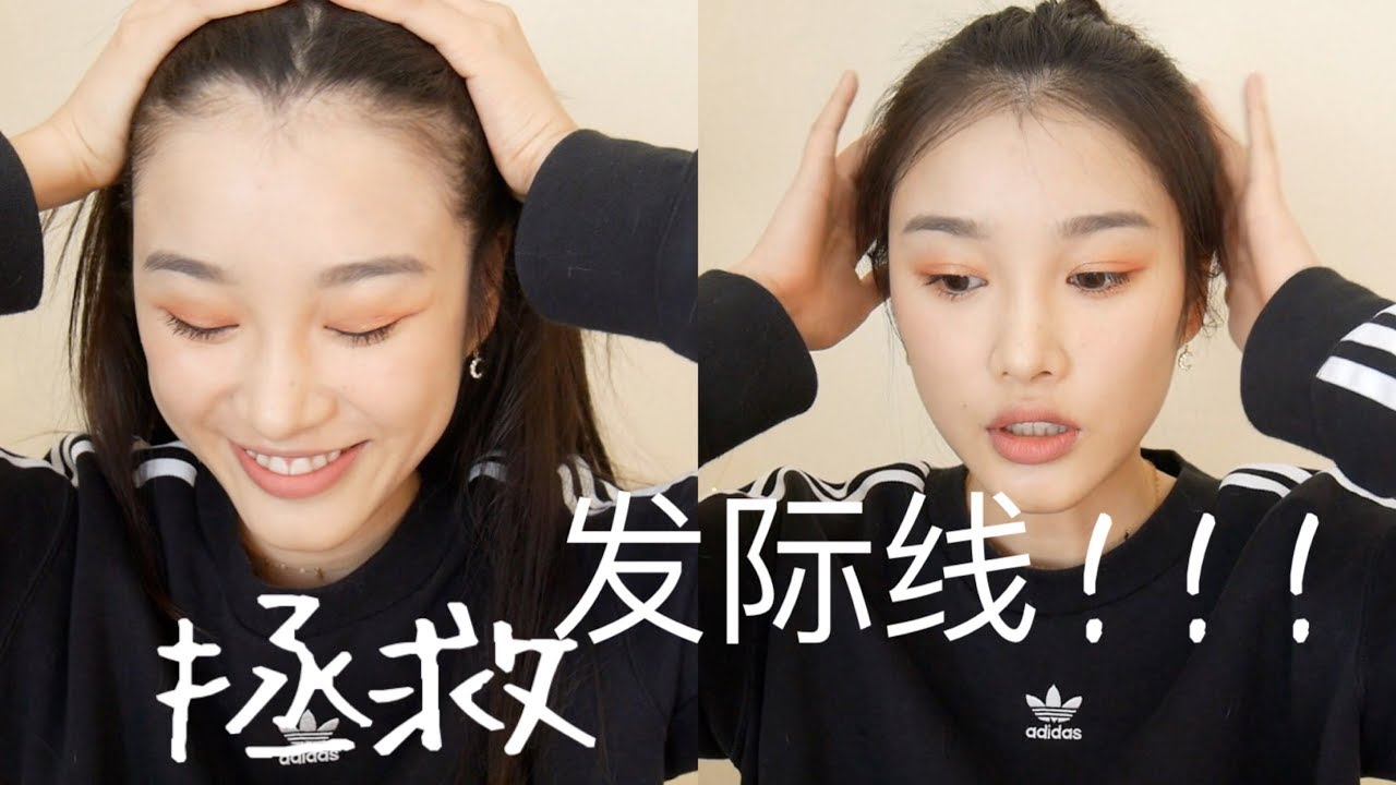 Receding Hairline / 快速拯救你髮際線的方法