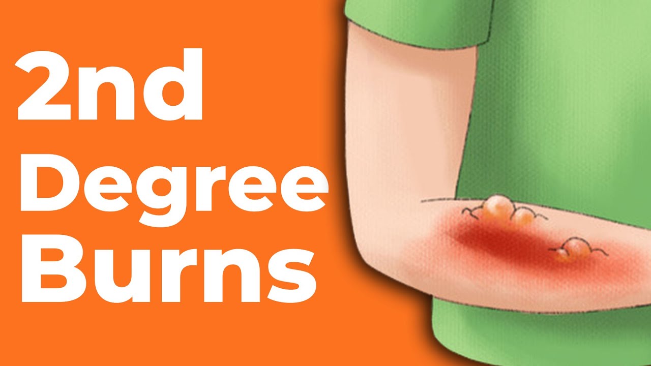 2nd Degree Burns: How to Treat Them | Wound Care OC