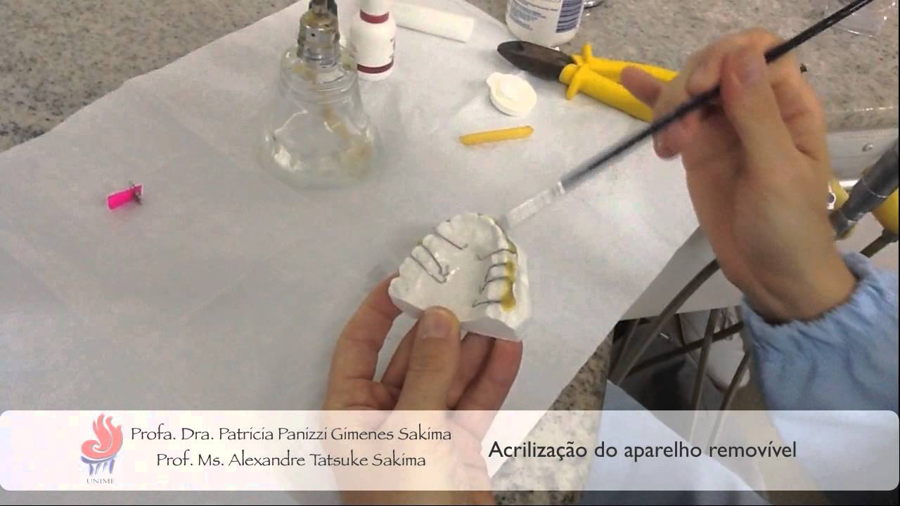 Acrilização do Aparelho Ortodôntico Removível