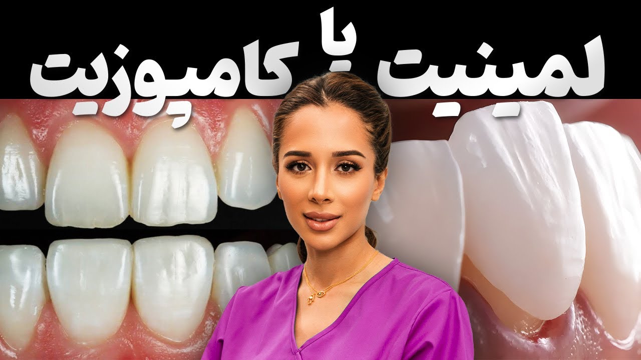 ⛔️مضرات لمینیت و کامپوزیت | لمینیت دندان یا کامپوزیت🦷⁉️| کدوم بهتره؟ Composite vs. Porcelain Veneers