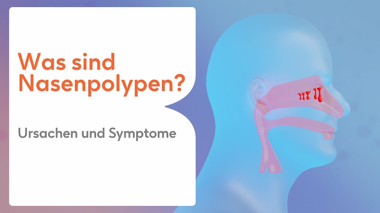 Was sind Nasenpolypen?