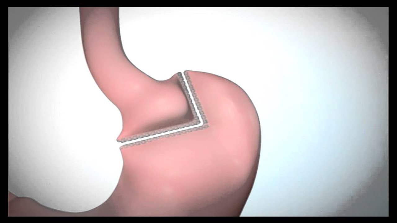 Roux en Y Gastric Bypass