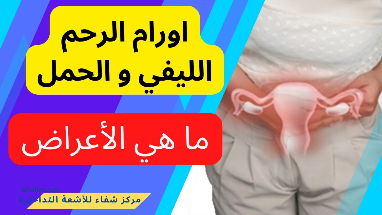 كيف تعرفي أن هناك ورم ليفي في الرحم؟ - أعراض الأورام الليفية و علاقتها بالحمل و الاجهاض