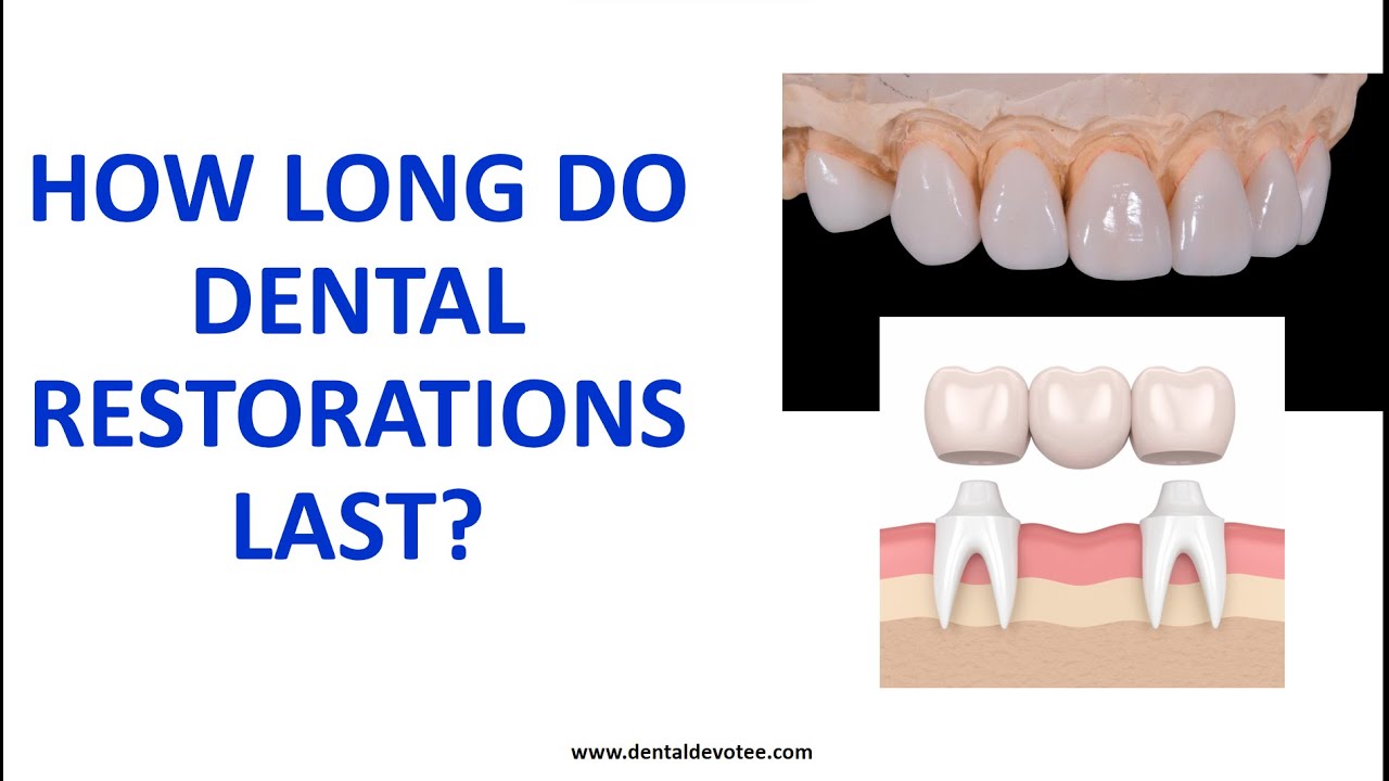 How long do Dental Restorations Last?