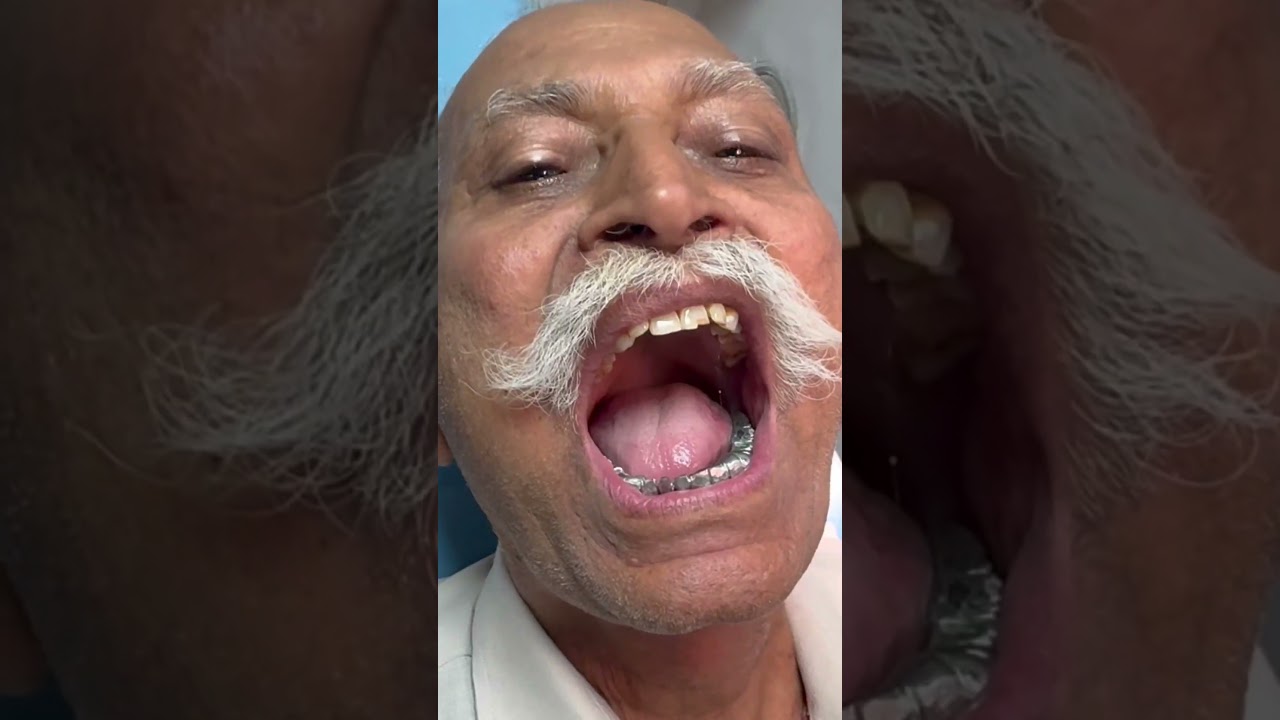 Metal tooth 😈 day23/100 smile back challenge 