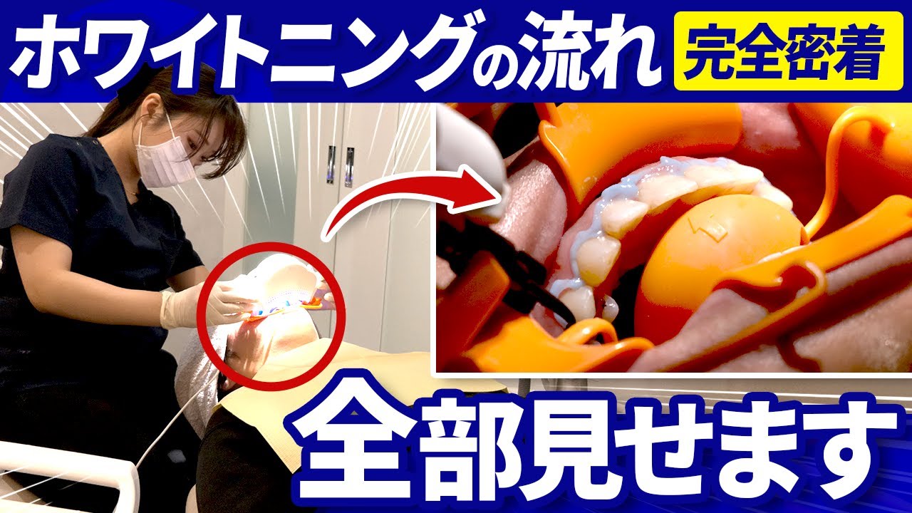 【完全密着Part2】ホワイトニング施術の裏側全部見せ！本当に痛くない？何分で終わる？