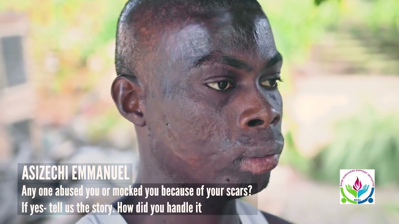 I SURVIVED BURNS .. Episode 1 . Real life stories of burn champions 