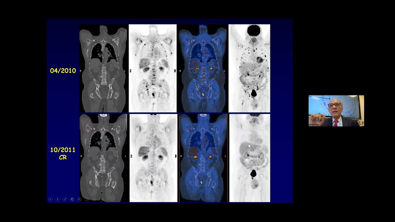 Myeloma 101: Diagnosis, Prognosis & Risk | Dana-Farber Cancer Institute