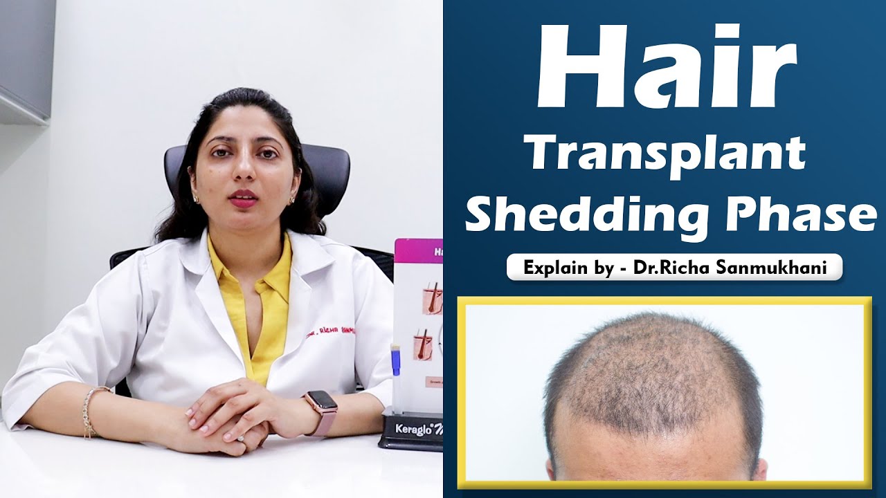 Hair Transplant Shedding Phase