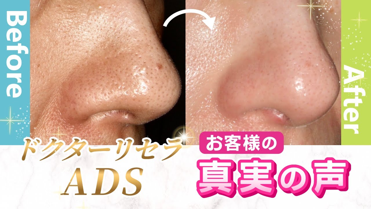 ドクターリセラADS「真実の声」　「毛穴・いちご鼻・シミ」