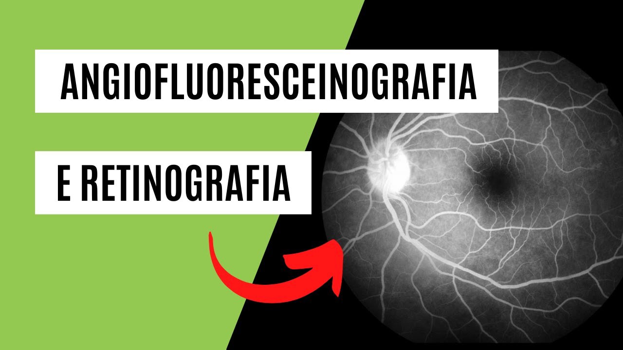 Angiofluoresceinografia e Retinografia - Exames dos olhos