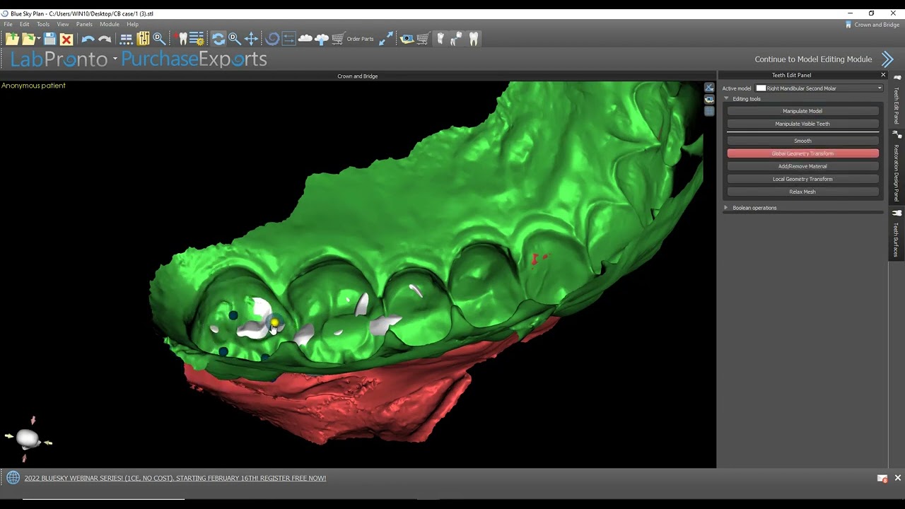 Designing an implant supported bridge in BlueSkyPlan