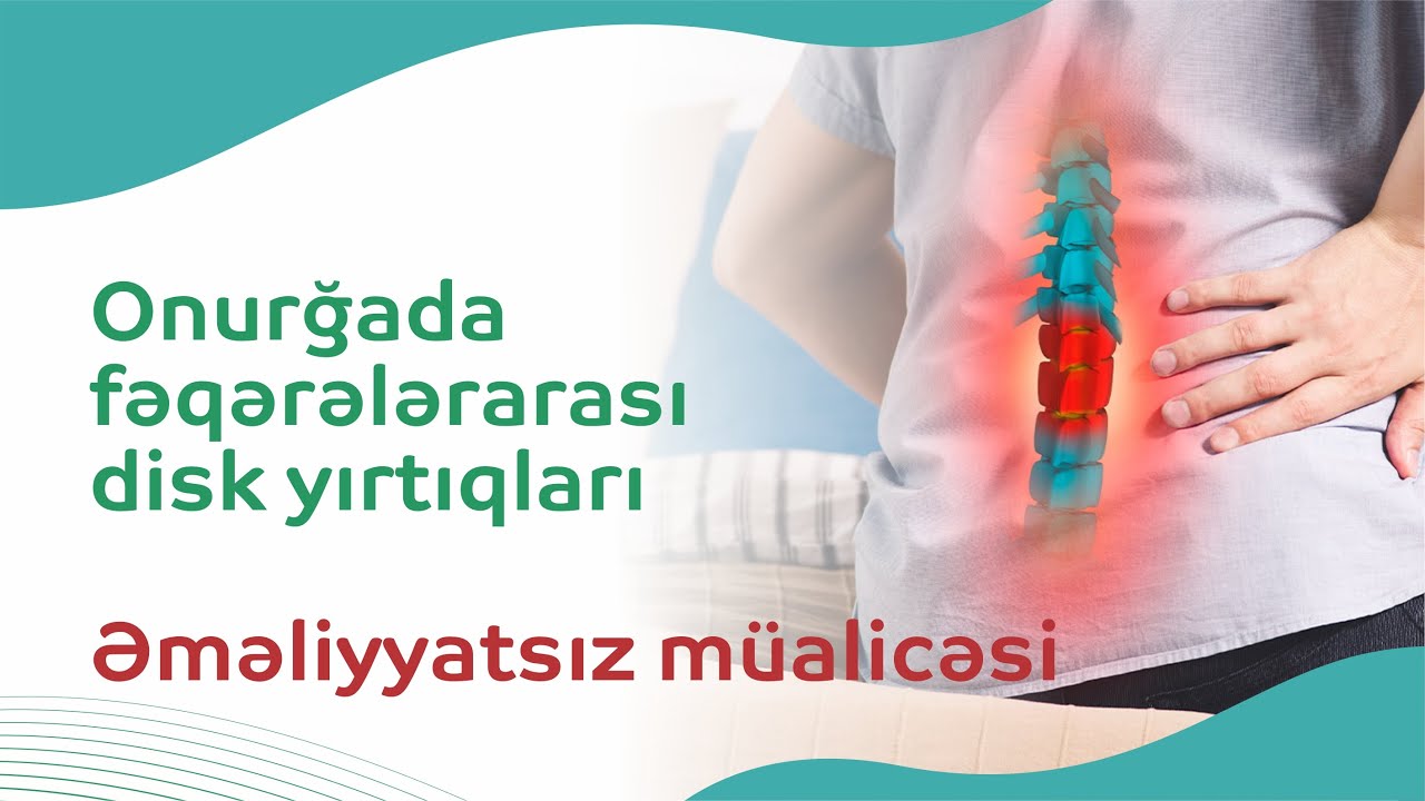 #Fəqərəarası disk yırtığı müalicədən sonra yarana bilərmi? - Həkim-fizioterapevtin açıqlaması