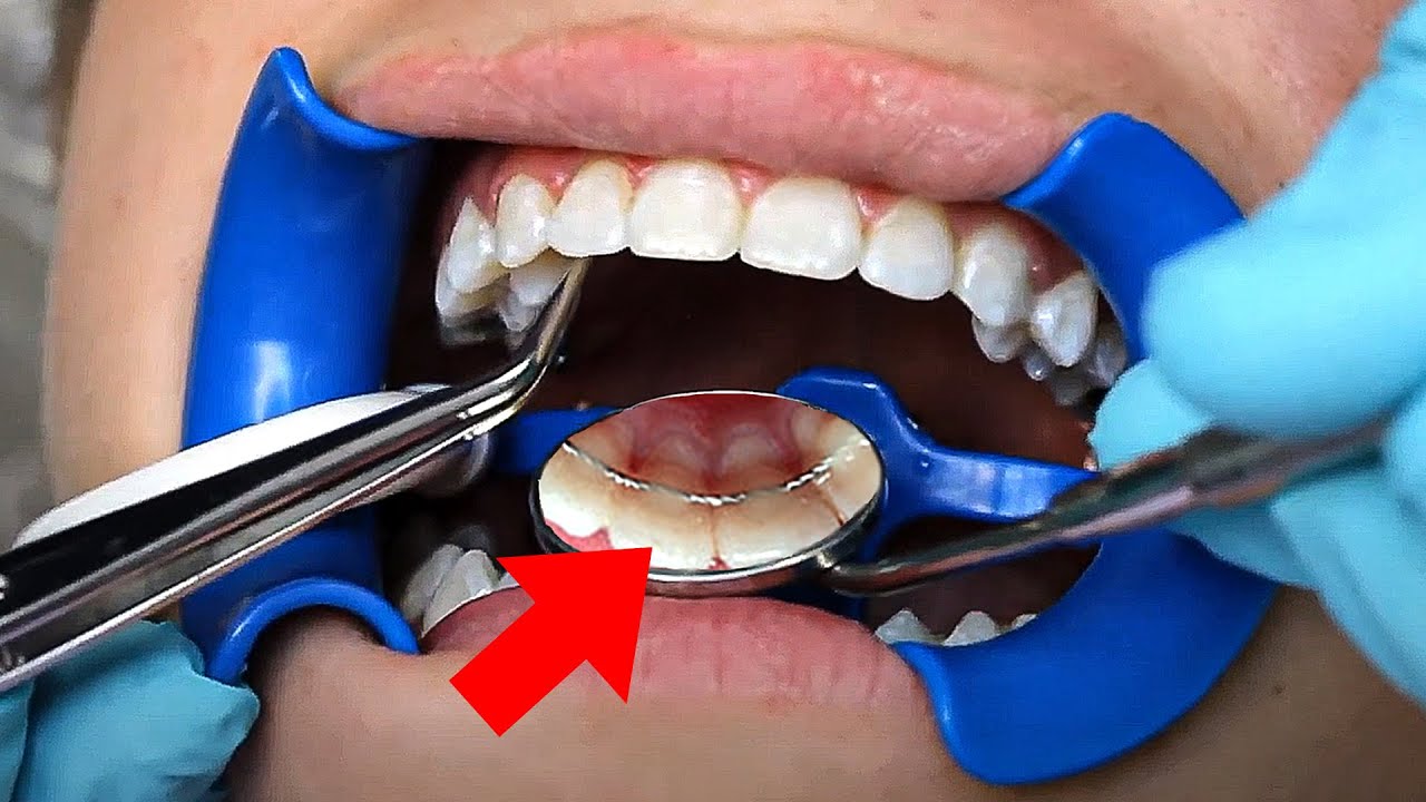 Permanent RETAINERS !!... How do they work? | McKinney Orthodontist