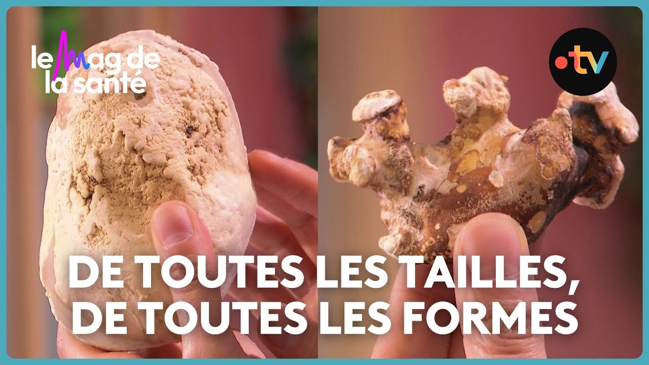 Calculs rénaux : pourquoi ça fait si mal ?