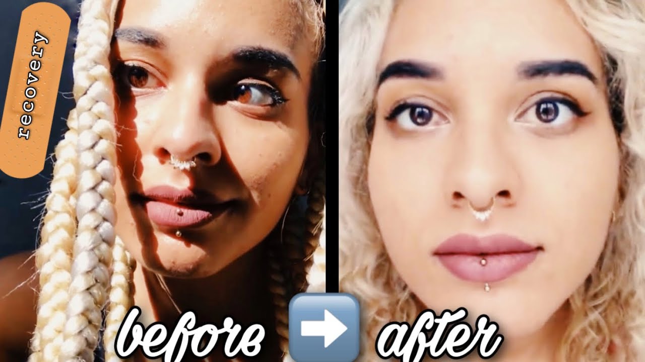 strabismus surgery recovery time lapse: my eyes for 31 days |  healing and results lazy eye surgery