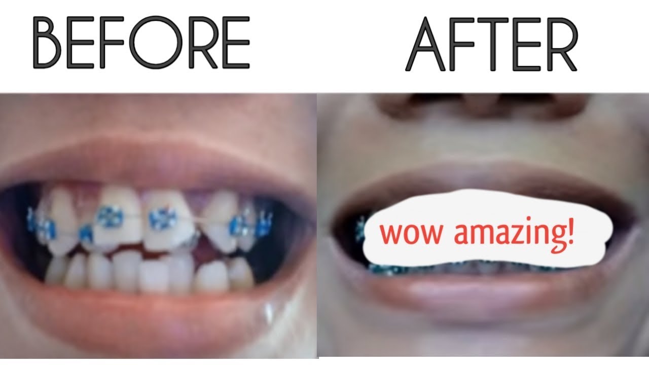 BRACES TIME LAPSE ( March 2017 to March 2019)