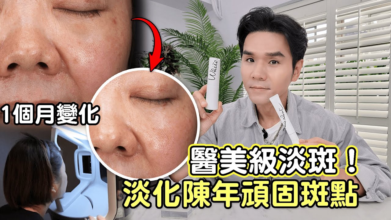 醫美級淡斑！搶救陳年超頑固斑點 連續擦1個月效果揭曉 ll Kevin想得美 ll Remove DARK SPOTS