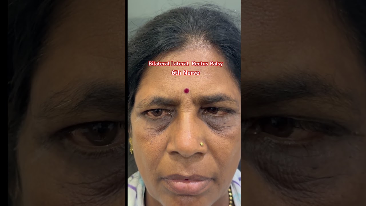 Bilateral Lateral Rectus Palsy - 6th Nerve #opthalmology #neuroscience #neurology