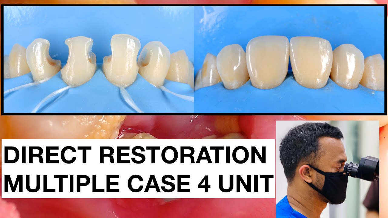 Direct Restoration Multiple Case | 2x SPEED | Tambal Gigi | Dokter Gigi Griya RR