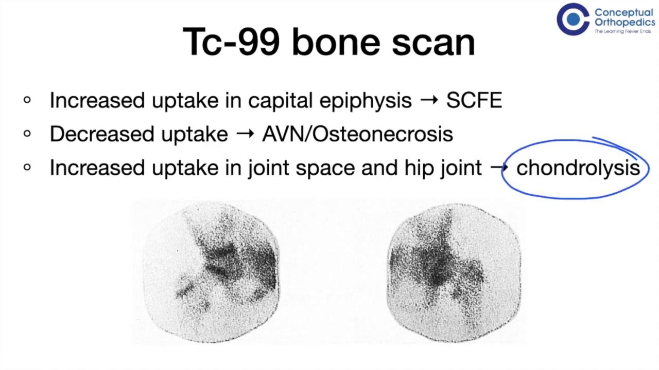 SCFE by Dr Faheem Kotekar @ConceptualOrthopedics