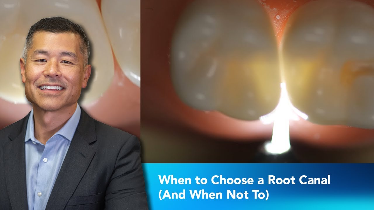 When to Choose a Root Canal (And When Not To) | Dentist 2 Dentist