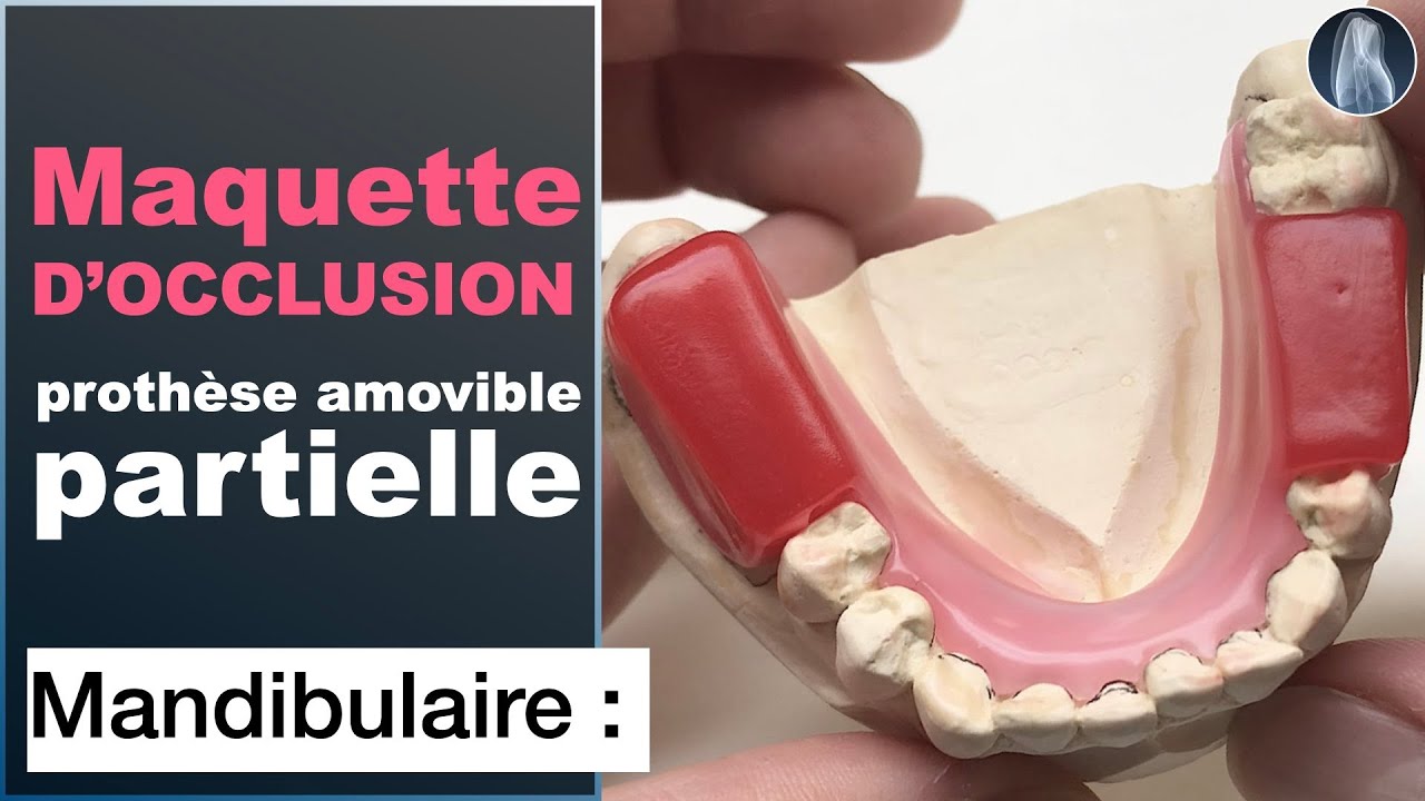 Concevoir une Base d’Occlusion Mandibulaire en Cire pour Prothèse Partielle | Guide Étape par Étape