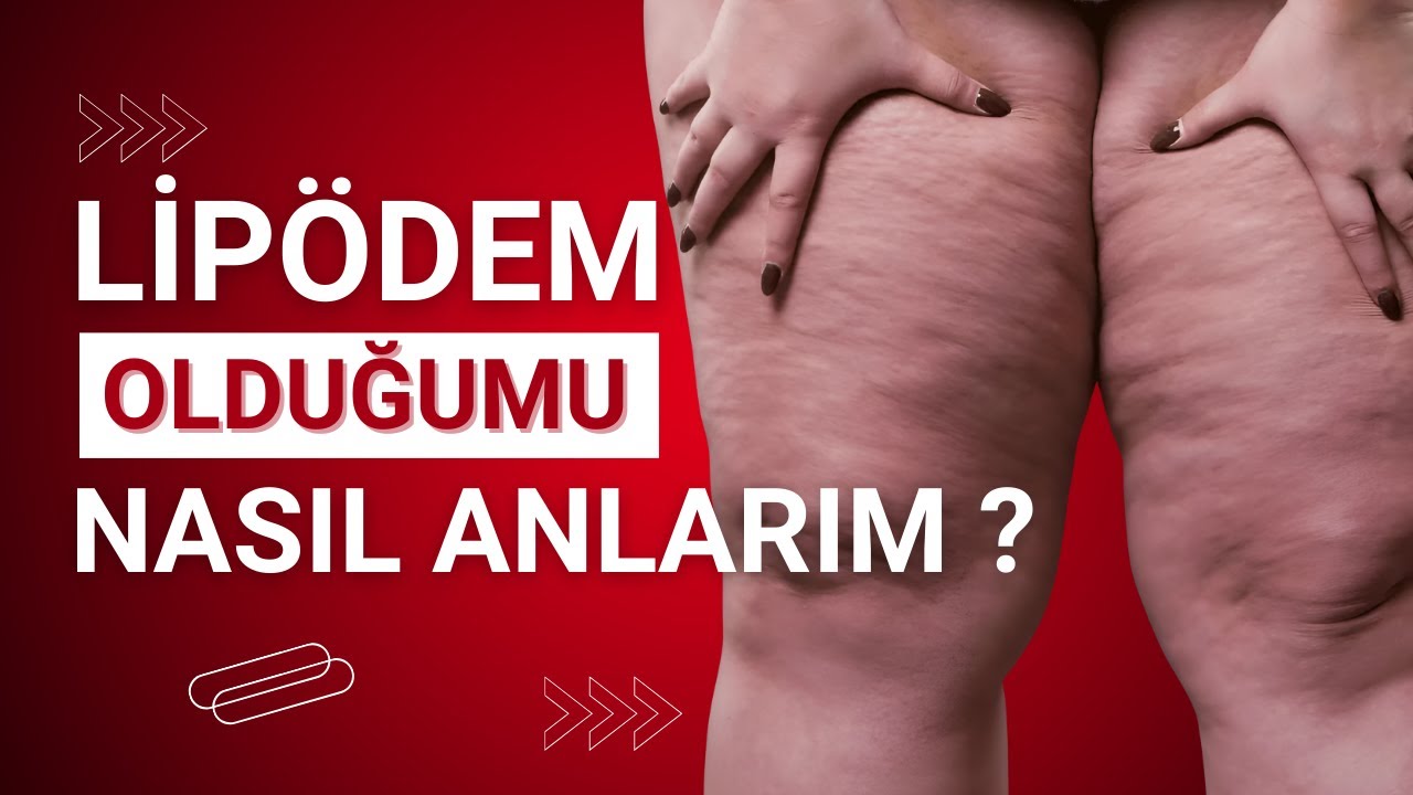 Lipödem Nedir? Lipödem Olduğunuzu Nasıl Anlarsınız? Belirtiler ve Çözümler