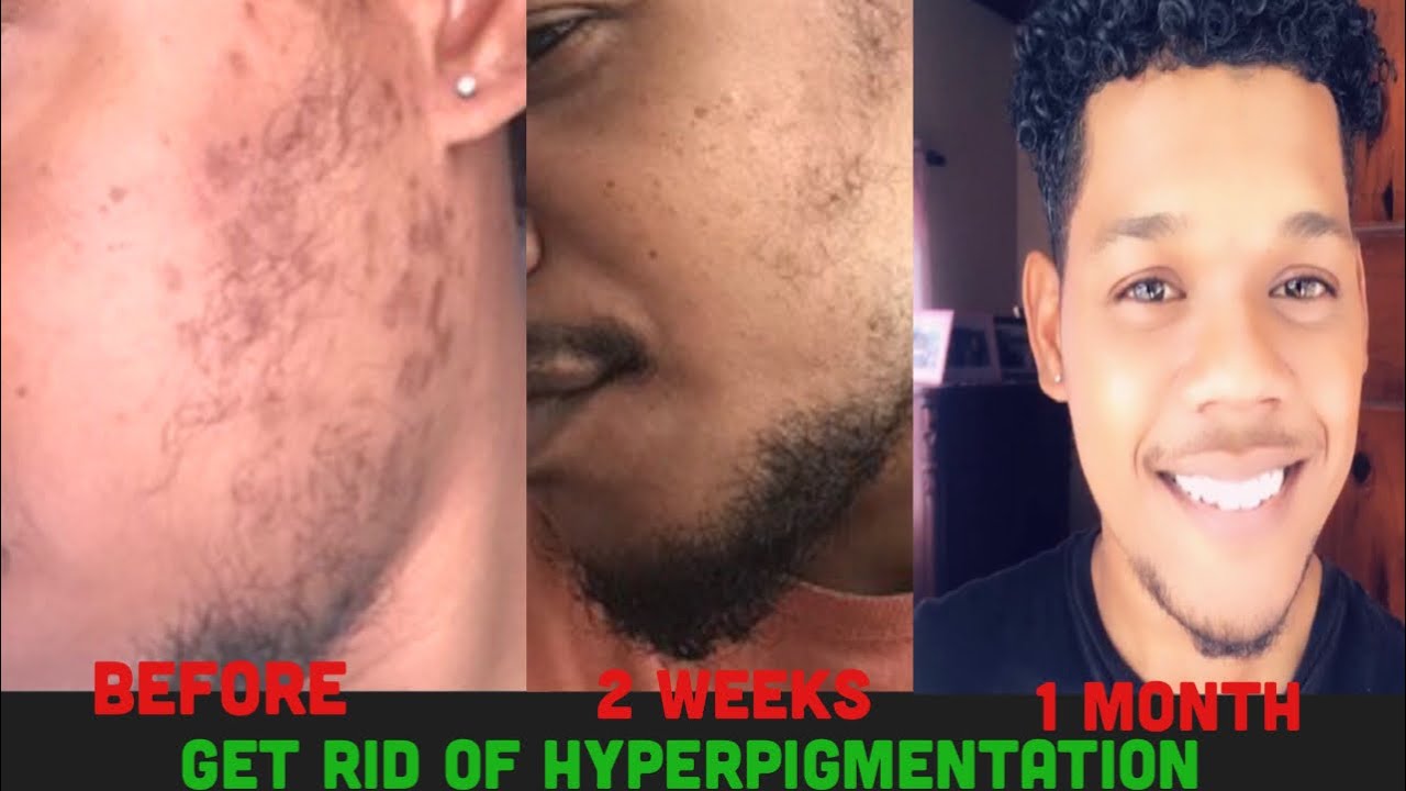 HOW TO GET RID OF DARK SPOTS/HYPERPIGMENTATION or ACNE AT HOME. REAL RESULTS: BRIGHT GLOWING SKIN