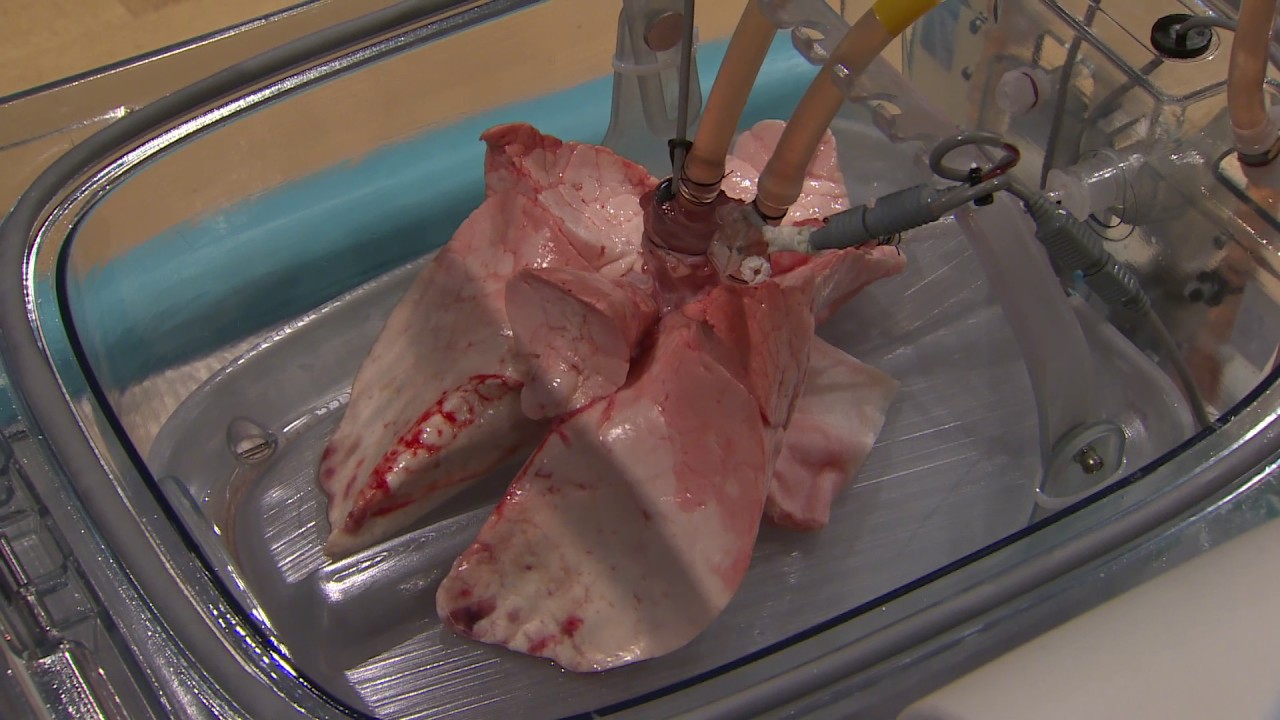 Dr Shaf Keshavjee | The Future of Lung Transplants
