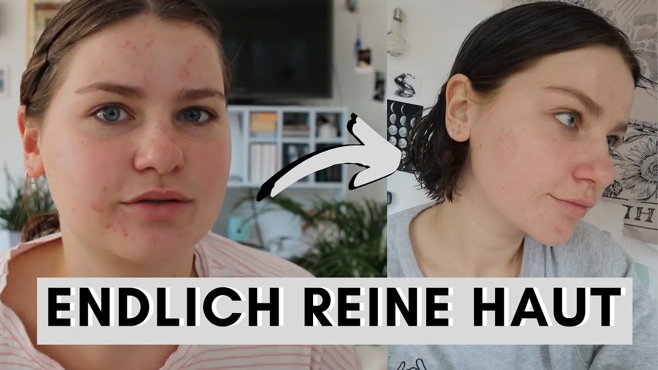 Schlechte HAUT nach Absetzen der PILLE: So habe ich sie wieder schön bekommen