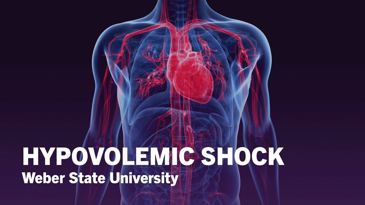 What Is Hypovolemic Shock? - Weber State University